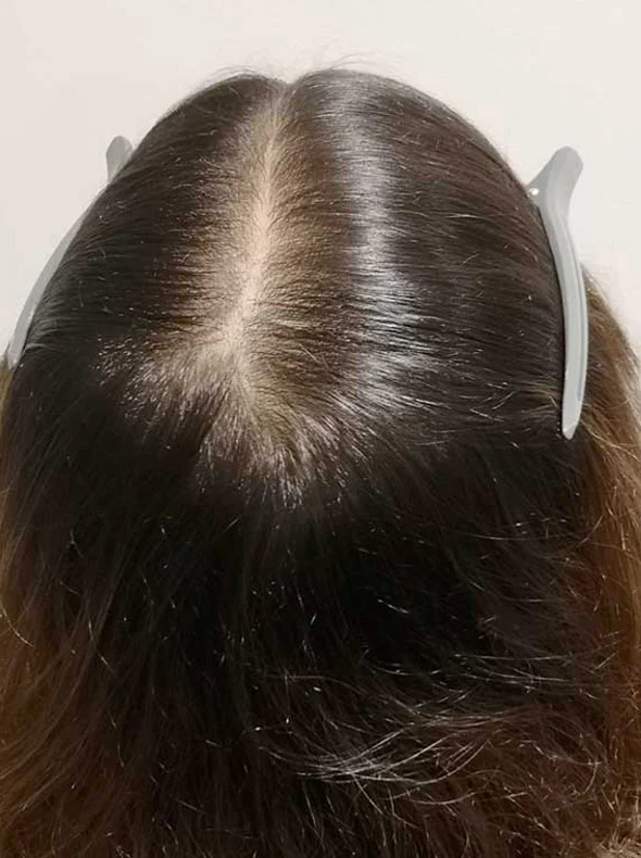 Da đầu vùng đỉnh đầu sau điều trị - khách hàng nữ