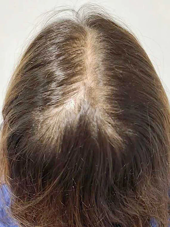 Da đầu vùng đỉnh đầu trước điều trị - khách hàng nữ