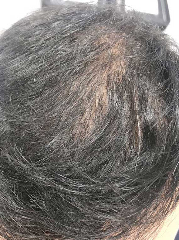 Sau điều trị phục hồi tóc