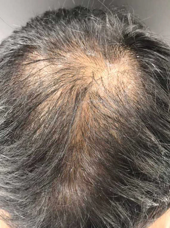 Trước điều trị phục hồi tóc
